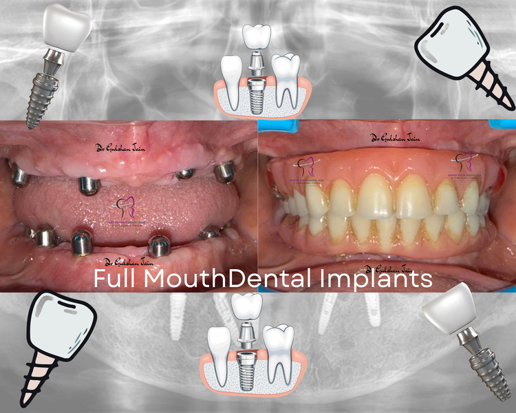 Cover photo of Dr Gulshan Jain MDS ( Napier Town Dental Hub )